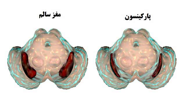 عکس بیماری پارکینسون