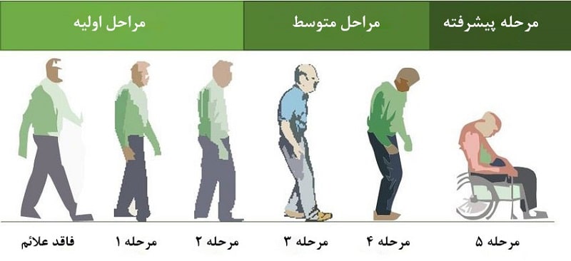 مراحل بیماری پارکینسون